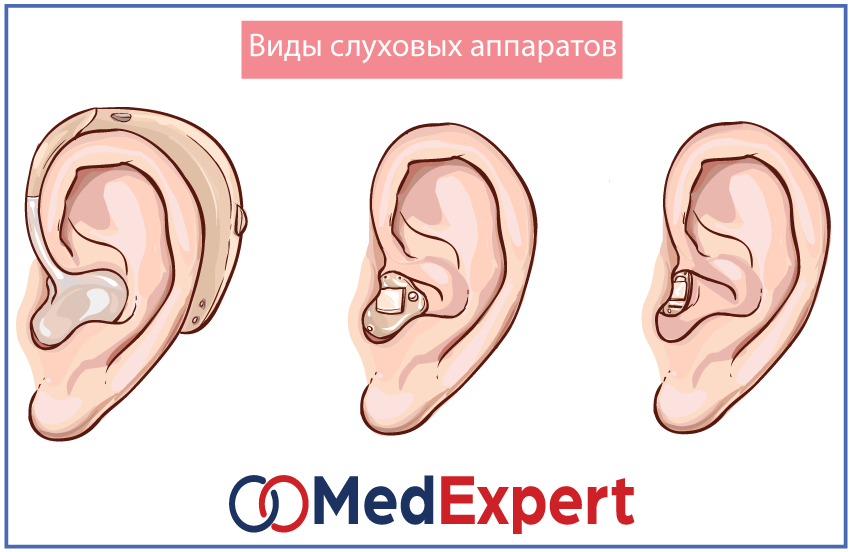 Виды слуховых аппаратов