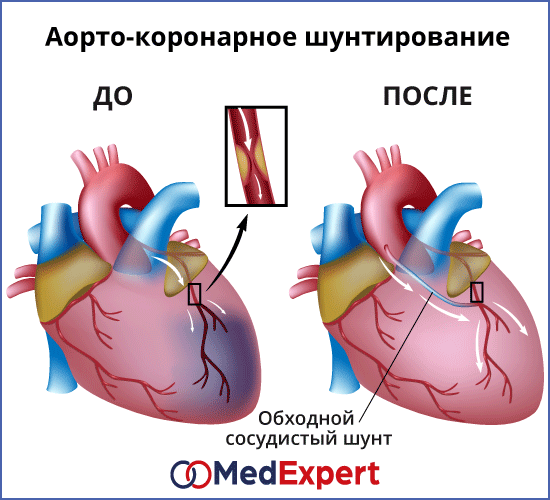 Диета После Шунтирования Сосудов Сердца