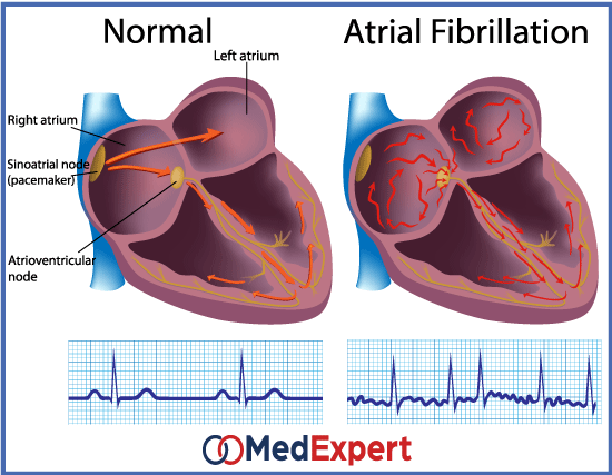 Atrial fibrillation; heart rhythm disorder; Atrial fibrillation treatment; catheter ablation; atrioventricular node ablation