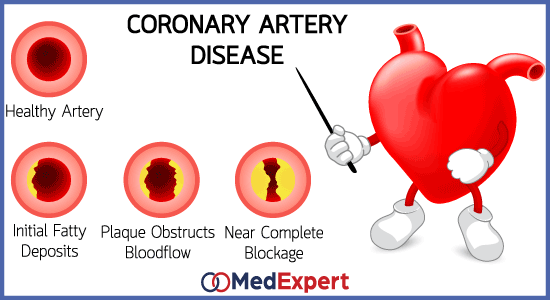 CAD symptoms; coronary artery disease; Coronary artery disease treatment; angioplasty and stenting; coronary artery bypass surgery