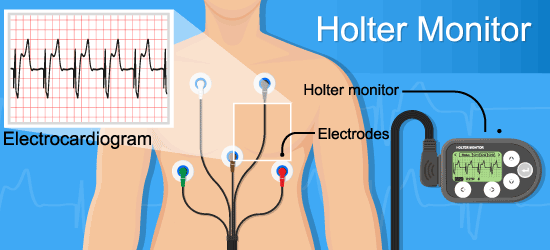 Atrial fibrillation; heart rhythm disorder; Atrial fibrillation treatment; catheter ablation; atrioventricular node ablation