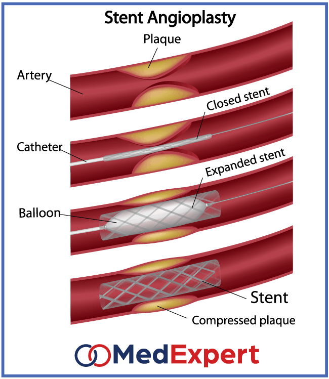 CAD symptoms; coronary artery disease; Treatment of coronary artery disease; angioplasty and stenting; coronary artery bypass surgery