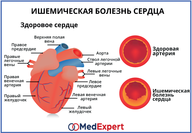 Реферат: Ишемическая болезнь сердца