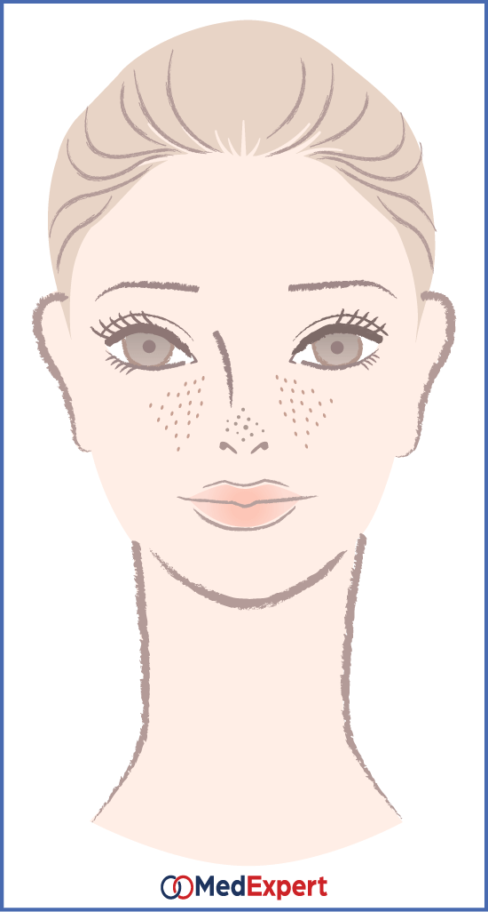 pigmentation; pores; Pigmentation, pores, redness treatment; Revlite; Cutera