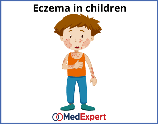 eczema diagnosis and treatment