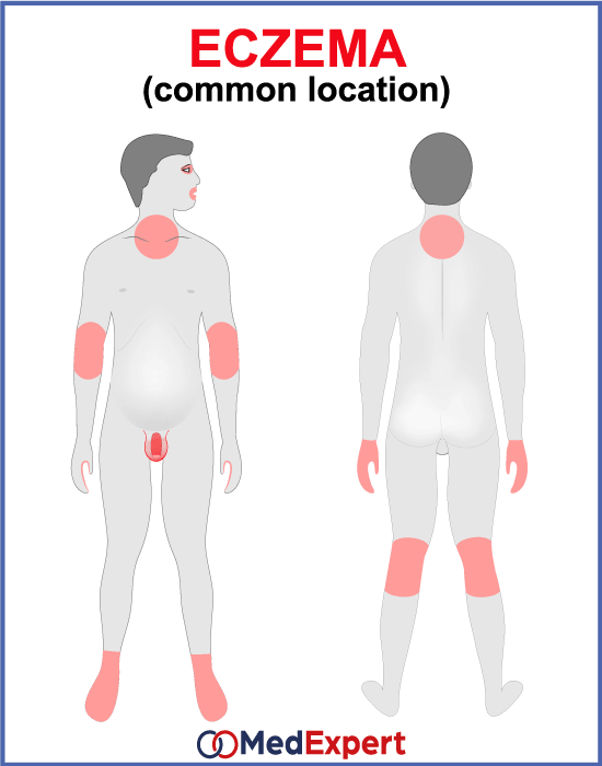 eczema; Eczema symptoms; Eczema treatment