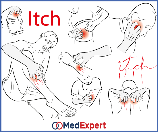 eczema symptoms and treatments itch