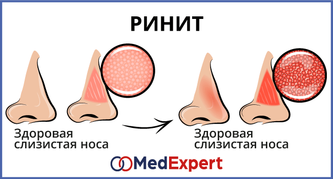 Лечение аллергического ринита у детей