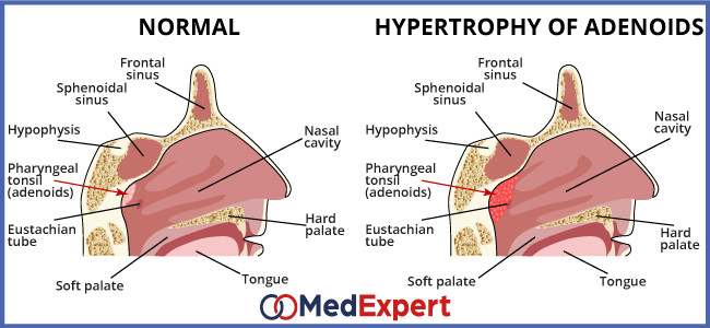 adenoiditis; Adenoiditis symptoms; Adenoiditis treatment; adenoidectomy