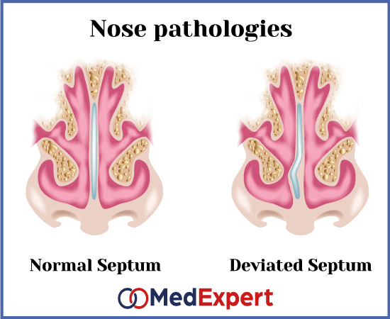 Deviated nasal septum; Deviated septum symptoms; Deviated nasal septum treatment