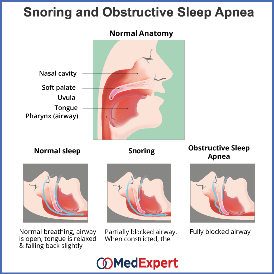 snoring; Snoring causes; Snoring treatment