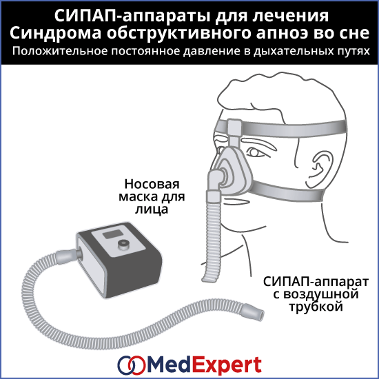 храп; Причины храпа; Лечение храпа, СИПАП-терапия