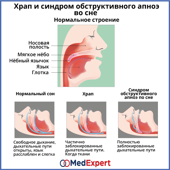храп; Причины храпа; Лечение храпа