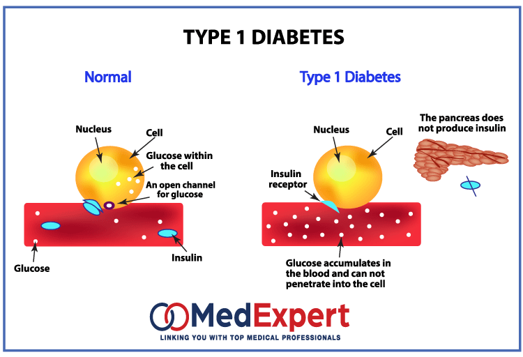 lada diabetes symptoms nhs