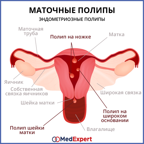 Как Выглядят Полипы В Матке Фото