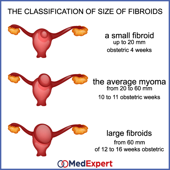 uterine fibroids; fibroid types; Uterine fibroids treatment