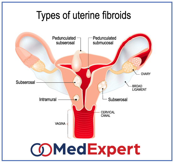 uterine fibroids; fibroid types; Uterine fibroids treatment