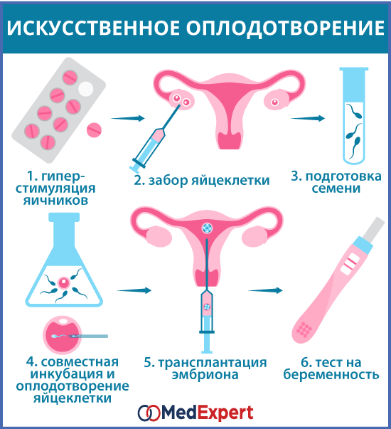 олигоспермия; низкое количество сперматозоидов; Лечение олигоспермии, эко