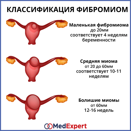 разлика между миома и миомен възел