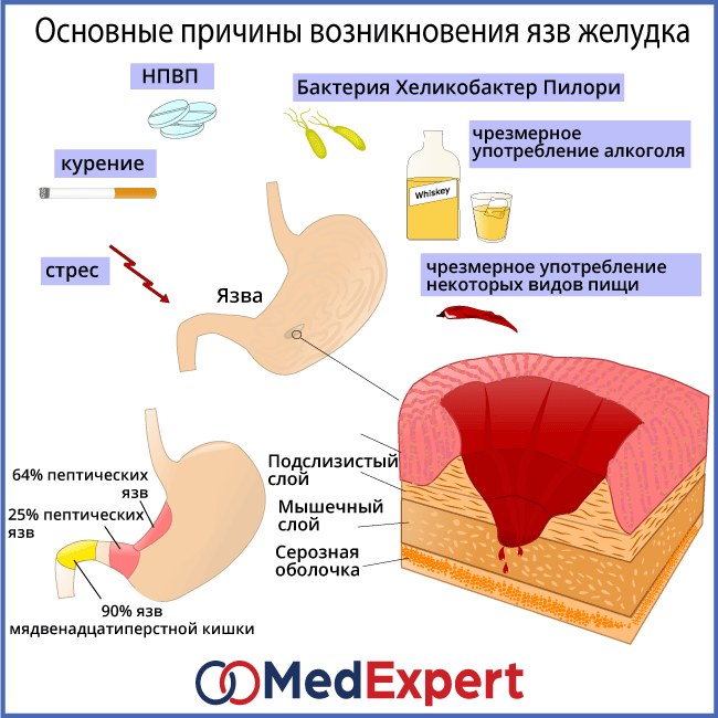 Язва Симптомы И Лечение Диета