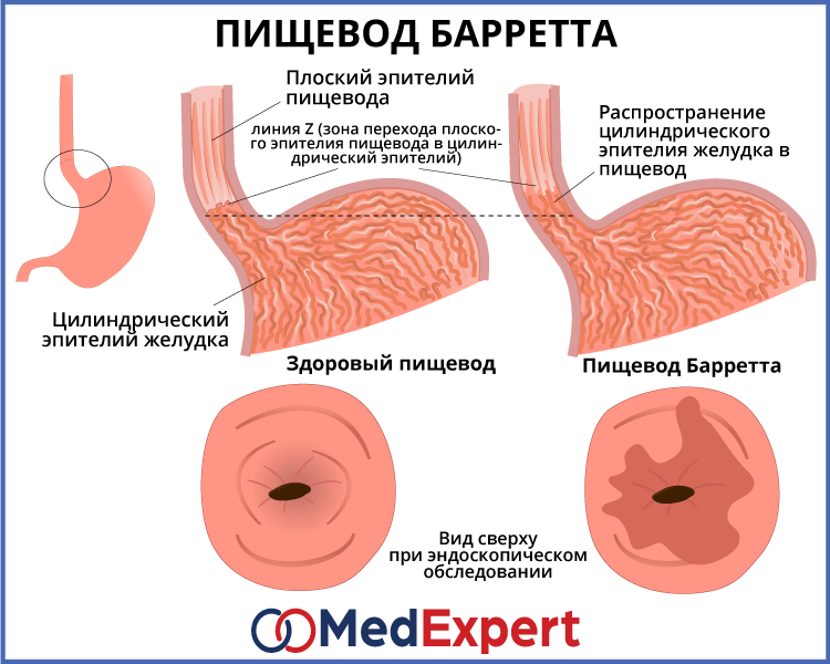 Диета При Пищеводе Барретта