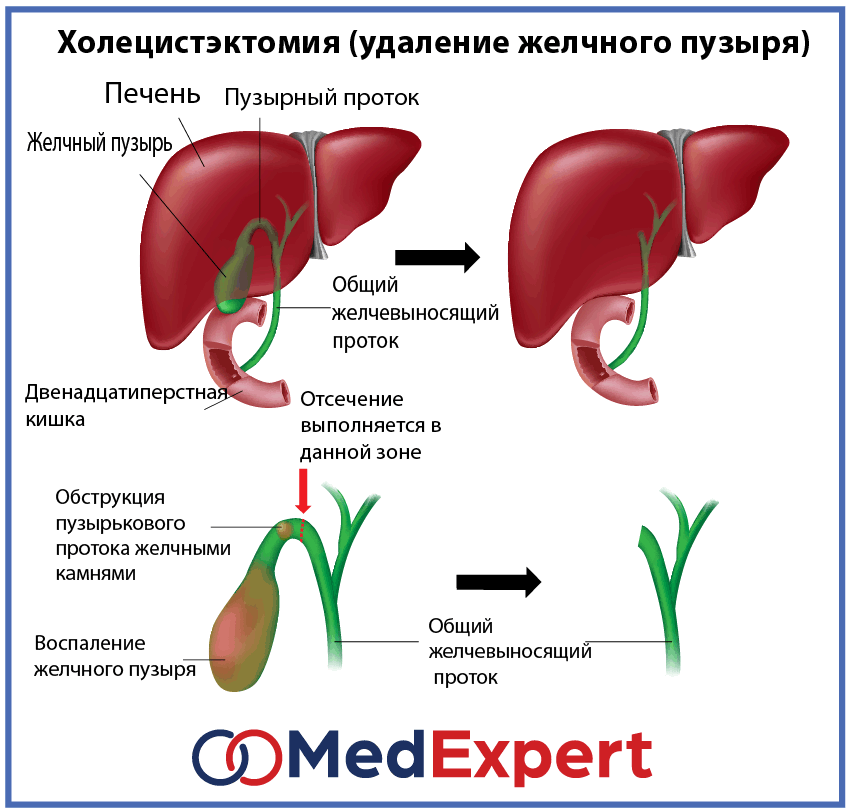 Доклад: Желчнокаменная болезнь