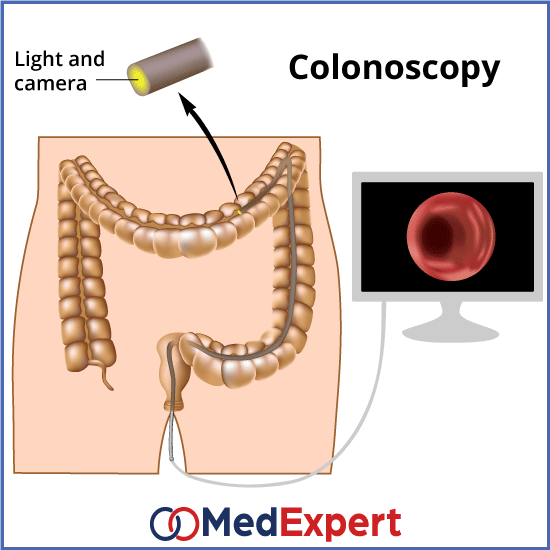 colon polyps diagnostics colonoscopy