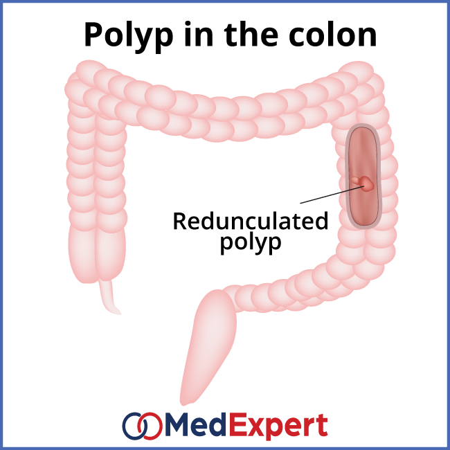 colon polyps; colon polyps symptoms; Colon polyps treatment; colonoscopy