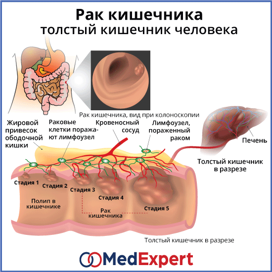 рак толстой кишки; Симптомы рака толстой кишки; Лечение рака толстой кишки