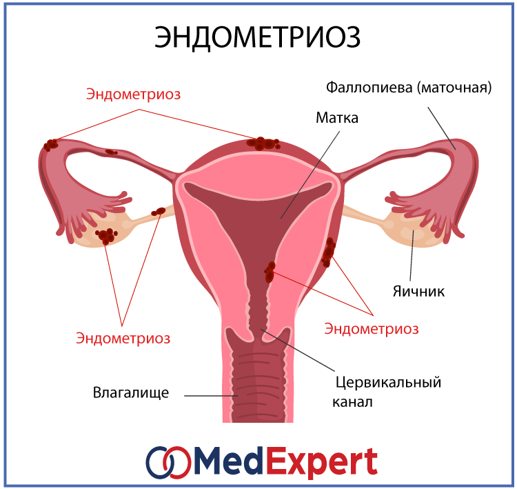 Как Выглядит Эндометрий Фото