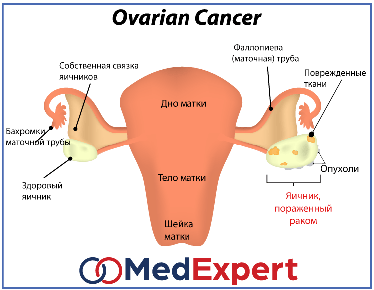 Рак Яичников Фото