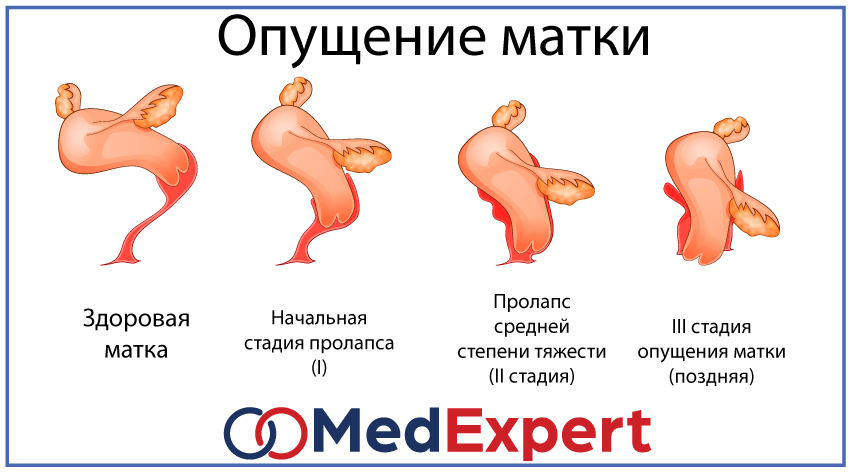 Пролапс тазовых органов; опущение матки; симптомы пролапса; Лечение опущения матки