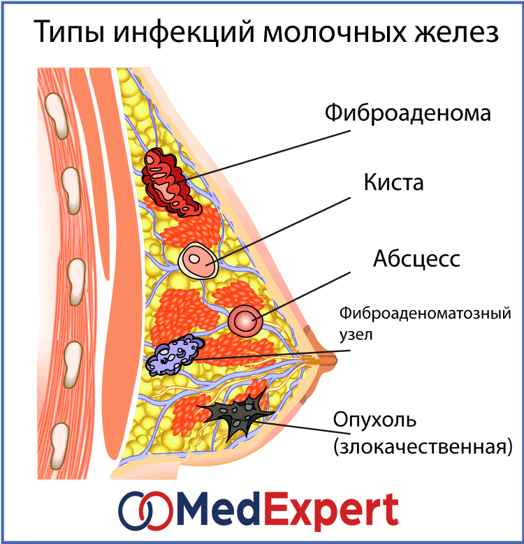 Фото Удаленной Молочной Железы