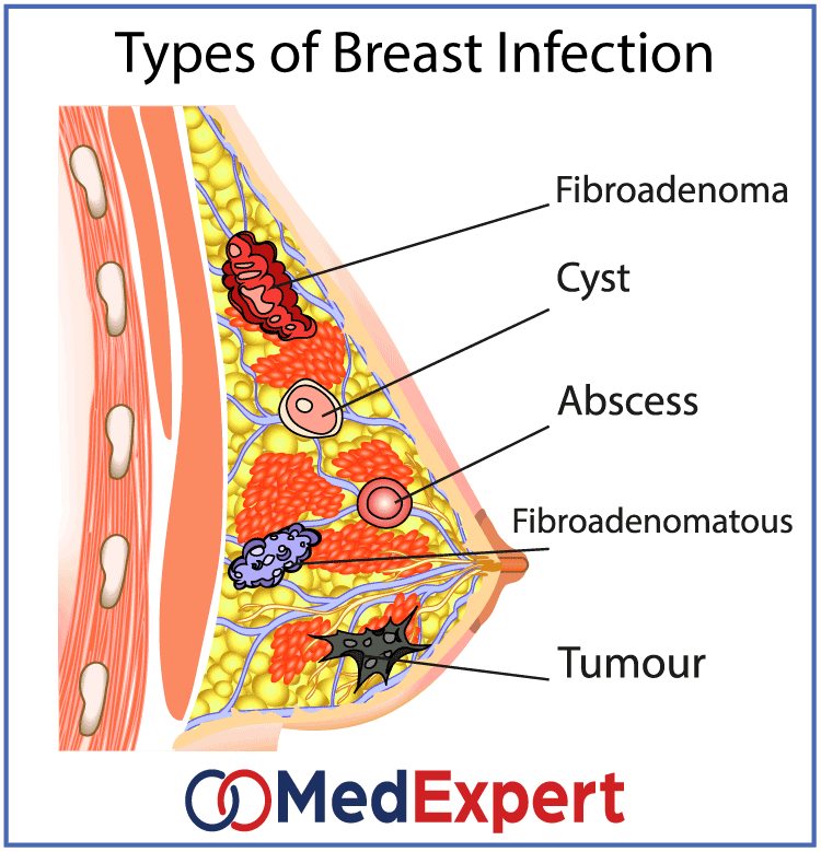 types of breast infection
