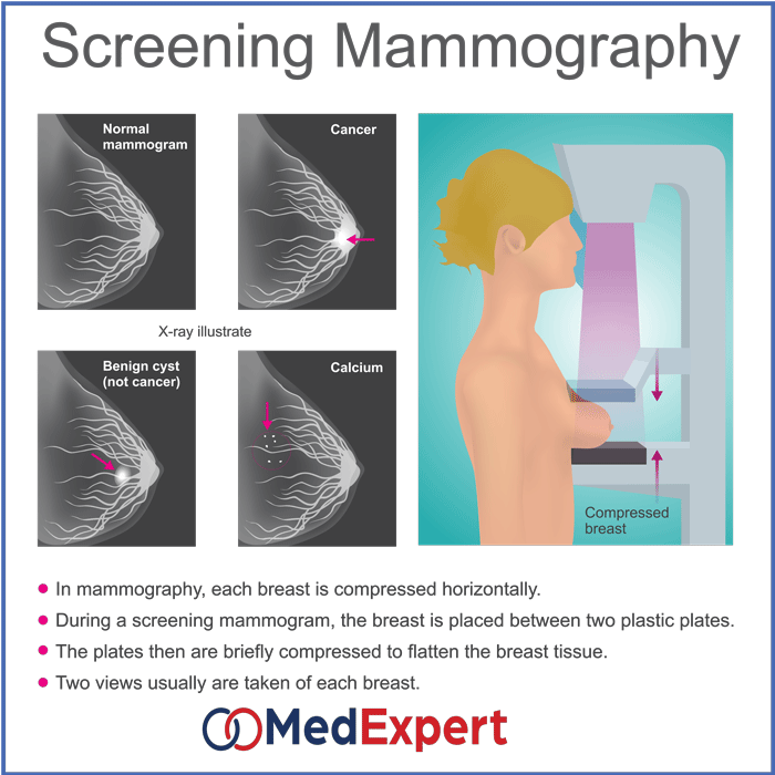 Mammogram - Diagnosing breast lumps