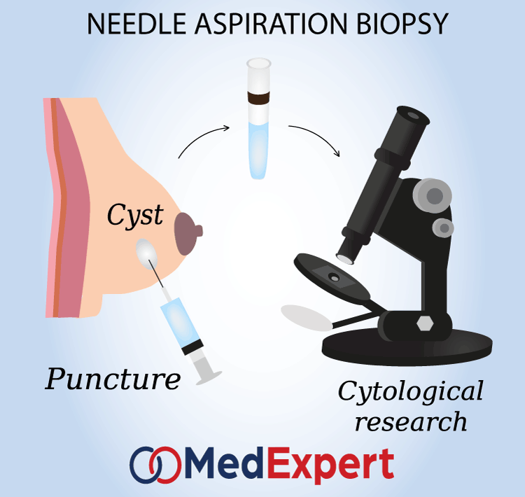 fine needle breast aspiration biopsy to diagnose breast cysts