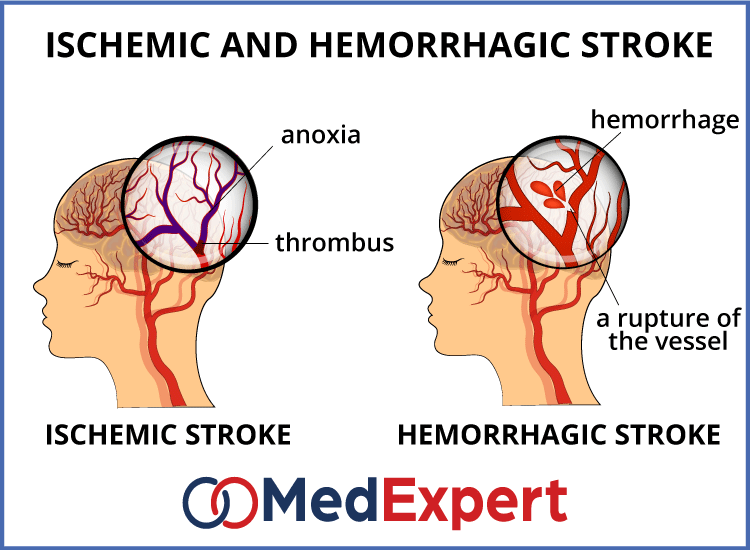 stroke causes and symptoms