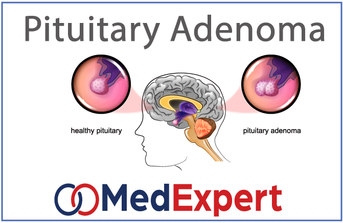 pituitary adenoma causes and treatment