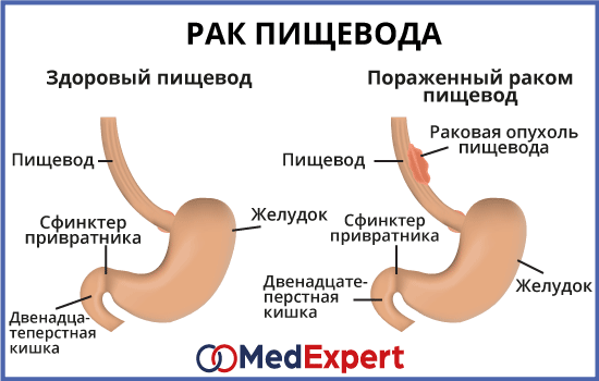 Реферат Рак Пищевода