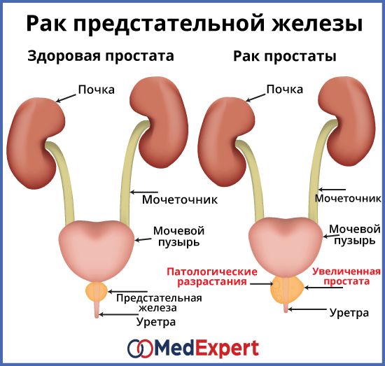 Доклад: Лучевая терапия рака предстательной железы