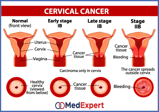 cervical cancer symptoms and treatment