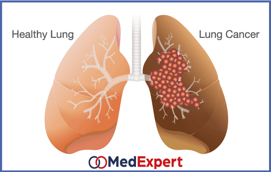 lung cancer; lung cancer prevention; Lung cancer diagnosis; lung cancer stages; lobectomy; pneumonectomy