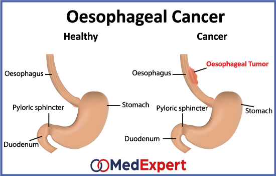 oesophageal cancer; Oesophageal cancer symptoms; Oesophageal cancer treatment