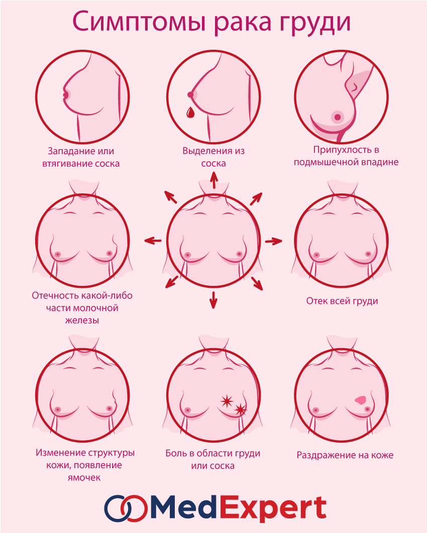 Рак Молочной Железы Симптомы И Признаки Фото