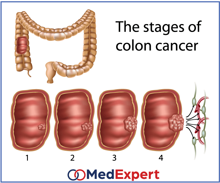 colon cancer; Colon cancer symptoms; Colon cancer treatment; Colon cancer diagnosis; colonoscopy