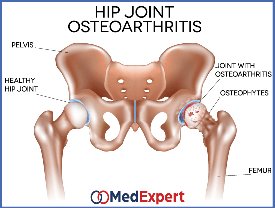 hip osteoarthritis; hip OA symptoms; Hip osteoarthrosis treatment; hip replacement