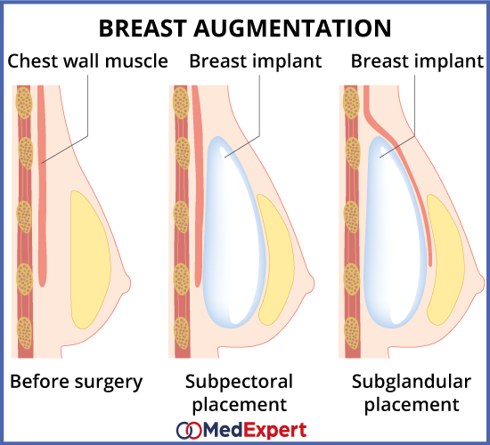 breast augmentation surgery and recovery