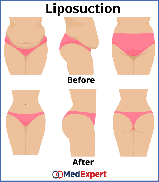 tummy fat removal, liposuction