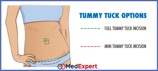 abdominoplasty, tummy tuck surgery