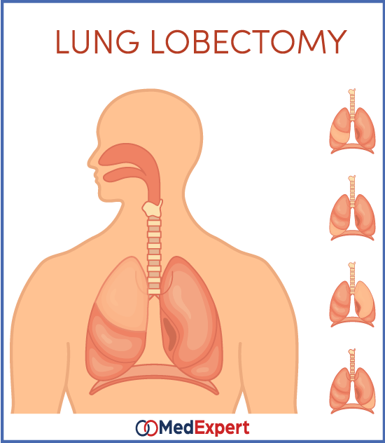 lung cancer treatment and diagnosis